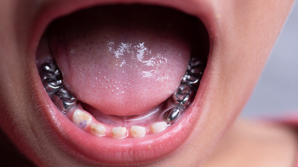 EPA Amalgam Separator Law Explained - HealthFirst